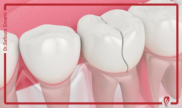 چگونه یک دندان ترک خورده را درمان کنیم؟
